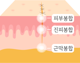 낭종/양성종양